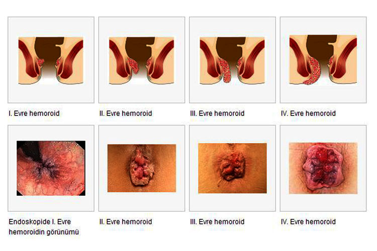 Hemoroid Hastal Nedir ? Hemoroid Belirtisi Ve Tedavisi Nelerdir ? 