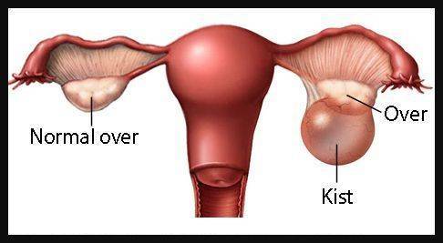 Kadn hastalklar kist nedir